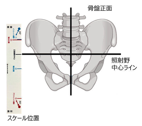 骨盤撮影補助具インレット・アウトレットガイドスケール